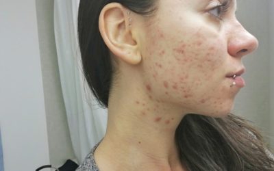 Here’s how I cured my hormonal acne 100% naturally