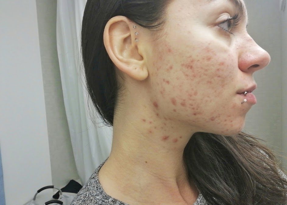 Here’s how I cured my hormonal acne 100% naturally