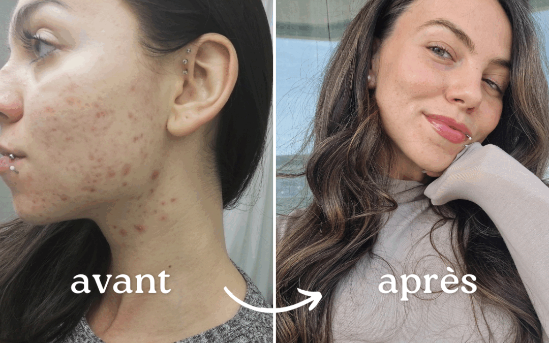 Acné hormonale : Comment je l’ai traitée 100% naturellement