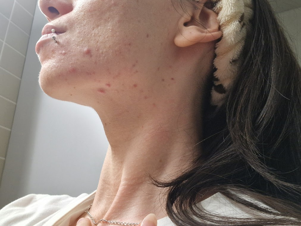 acneÌ hormonale